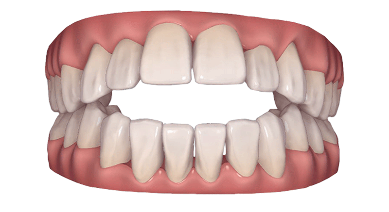 治療が必要な歯並びの種類 イロドリ矯正歯科