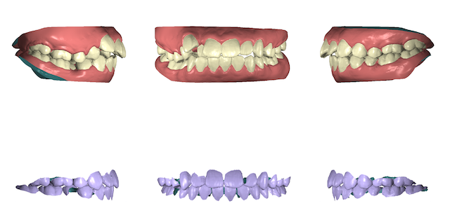 治療のシミュレーション イロドリ矯正歯科